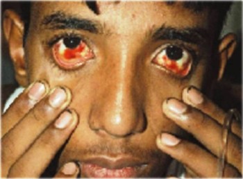 7. Pain behind the eyes e1316539199600 10 Dengue Fever Symptoms