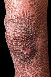 1. Ichthyosis e1319791341749 10 Very Rare Diseases Found in Human Body