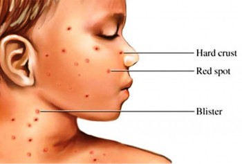 3. Chicken Pox e1318356369534 Top 10 Viral Diseases in the World