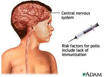 4. Poliomyelitis e1318356307874 Top 10 Viral Diseases in the World