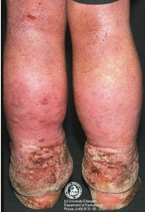 8. Elephantiasis e1319790887980 10 Very Rare Diseases Found in Human Body