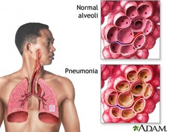 8. Pneumonia e1318356021322 Top 10 Viral Diseases in the World