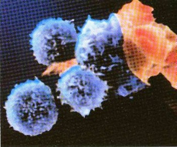 Top 10 Viral Diseases in the World 9. AIDS e1318355970829 Top 10 Viral Diseases in the World