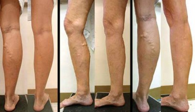 10. Varicose Veins e1349939630105 Top 10 Pregnancy Problems