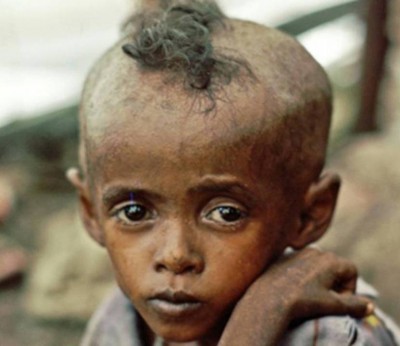 2. Ethiopia e1350405594827 Top 10 Most Malnourished Nations in the World