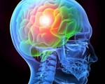 3. Brain InjuryDefects