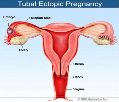 3. Ectopic Pregnancy e1349939522725 Top 10 Pregnancy Problems