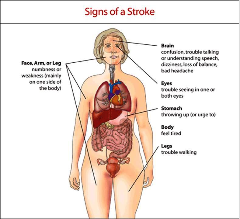 Signs of a Stroke