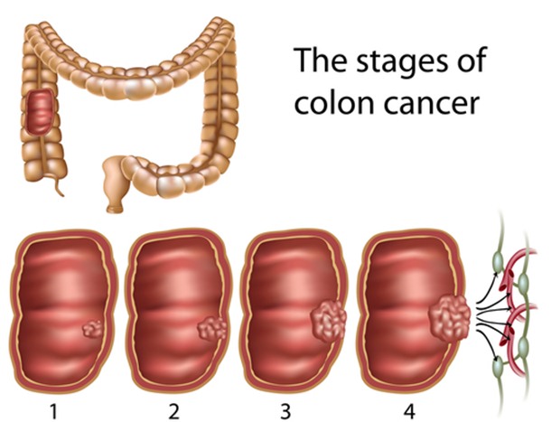 10 Unknown Facts About Colorectal Cancer